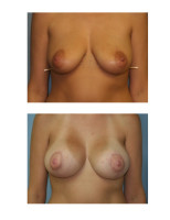 breast-augmentation-with-lift_007