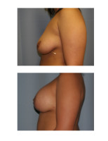 breast-augmentation-with-lift_008