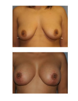 breast-augmentation-with-lift_009