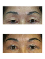 eyelid-surgery-blepharoplasty_001