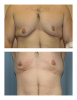 gynecomastia-male-breast-reduction_001