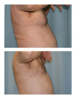 gynecomastia-male-breast-reduction_004