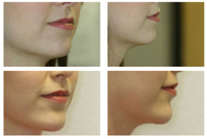 neck-liposuctions_001