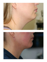 neck-liposuctions_003