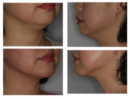 neck-liposuctions_004