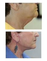 neck-liposuctions_006