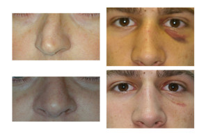 nose-reshaping_005
